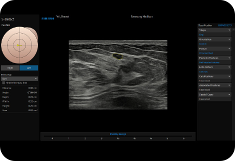 img_S-Detect-Breast